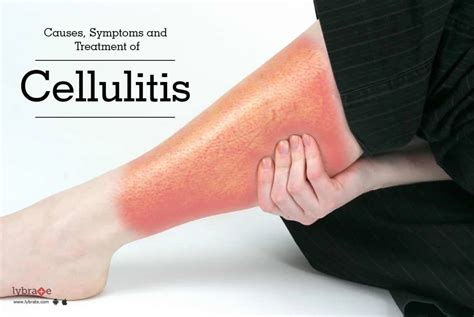 cul cellulite|signs and symptoms of cellulite.